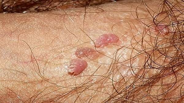 Image mụn cóc ở nam