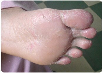 á sừng ở bàn chân