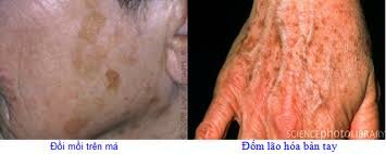 đốm đồi mồi