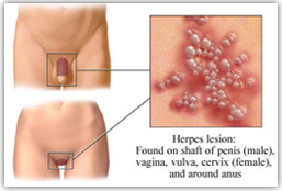 Herpes sinh dục
