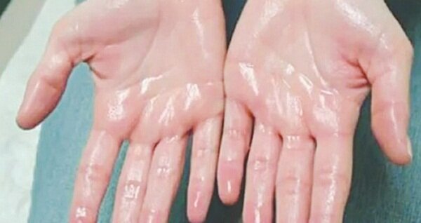 Cách khắc phục chứng ra mồ hôi tay mồ hôi tay
