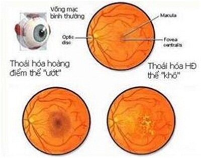 thoái hoá điểm vàng ướt