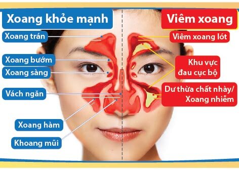 viêm mũi dị ứng