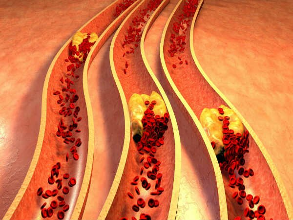 Giảm cholesterol